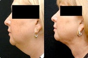 Smart Lipo: Chin Area