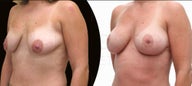 Breast lift with implants and fat grafting