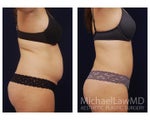 Liposuction