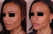 Rhinoplasty