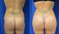 Buttock augmentation
