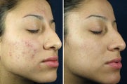 Chemical Peel