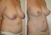 Mommy makeover (breast lift, tummy tuck, liposuction)