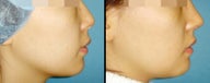 Rhinoplasty