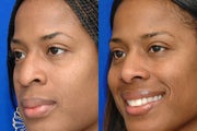 African american Rhinoplasty