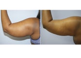 29 Year Old Female - Liposuction of Arms, Abdomen, and Back