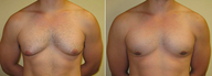 Male Breast Reduction