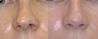 Revision Rhinoplasty