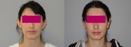 Otoplasty