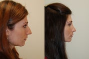 Rhinoplasty Surgery. 6 months post-op.