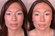 Rhinoplasty
