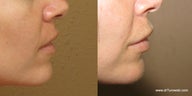 Lip augmentation