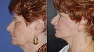 Facelift