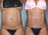 53 Year Old Female Treated To Increase Definition U/L Abs Flanks Loss 4.5"