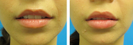 28 Year Old Female for Lip Augmentation