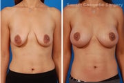 Benelli Mastopexy and Nipple Enhancement