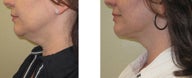 Chin liposuction/Liposculpture