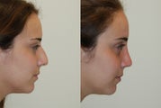 Rhinoplasty Surgery. 6 weeks post-op.