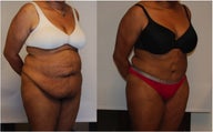 Large Abdominoplasty 3 months before and after