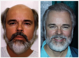 Hair Transplant