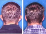 Male Otoplasty