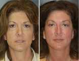 Facelift