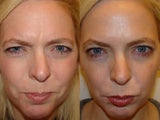 Female treated for glabella and wrinkles on forehead