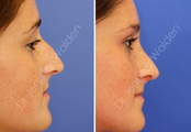 Septorhinoplasty