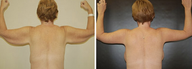 Arm Lift