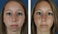 Chin Implant Before & After