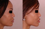 Rhinoplasty