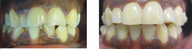 Teeth makeover with Invisalign