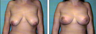 Breast lift