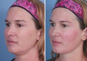 Thermage before and immidately after