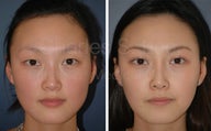 Asian Eyelid Surgery