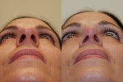 Rhinoplasty Surgery. 1 year post-op.