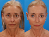 Laser Resurfacing Before & After