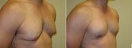 Male Breast Reduction