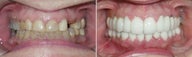 Dental Implants and Crowns