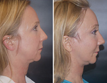 Facelift