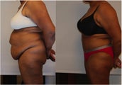 Large Abdominoplasty 3 months before and after