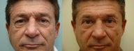 Upper & Lower Eyelid Surgery
