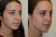 Rhinoplasty Surgery. 6 weeks post-op.