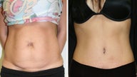 Weight Loss