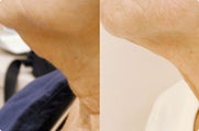 Smart Lipo: Chin Area