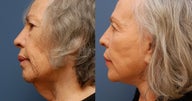 Necklift
