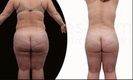 42 year old women body shaping with body jet liposuction