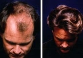Hair replacement with Fleming/Mayer flap