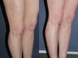 Sclerotherapy For Leg Veins