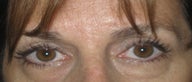 Lower Eyelid Surgery